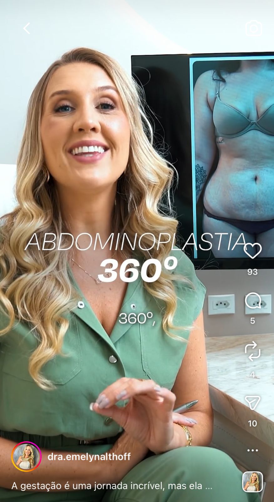Reel sobre abdominoplastia da Dra. Emelyn no Instagram
