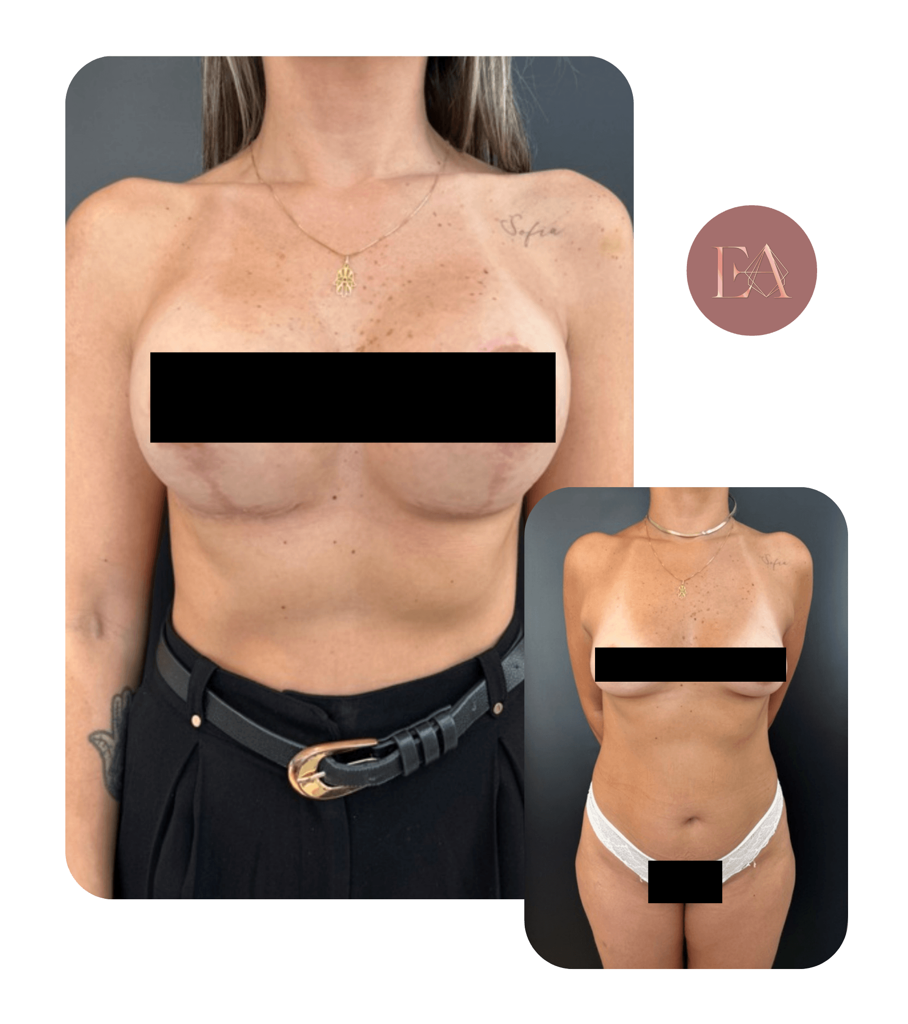 Antes e depois de paciente da Dra. Emelyn